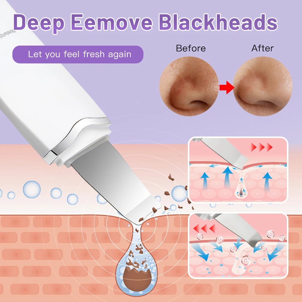 Electric Ultrasonic Skin Scrubber – Face Spatula for Blackhead Removal & Facial Lifting